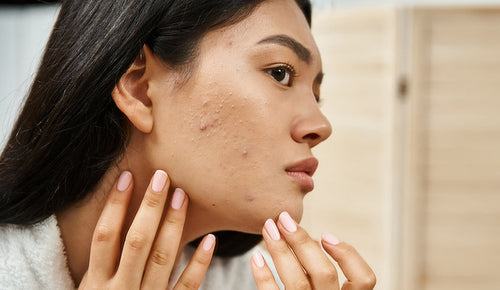 Voici 5 bienfaits du miel de Manuka contre l'acné